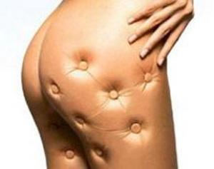 La cellulite sul sedere si può eliminare?