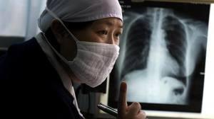 PECHINO:GRAVE EPIDEMIA DI TUBERCOLOSI