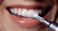 Lavarsi i denti subito dopo mangiato fa bene o male allo smalto?