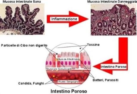 La sindrome della permeabilità intestinale, celiachia, sensibilità al glutine, spettro autistico, microtossine e tolleranza immunologica