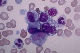 Dal virus dell’HiV “disattivato” un’inaspettata speranza per la lotta alla leucemia