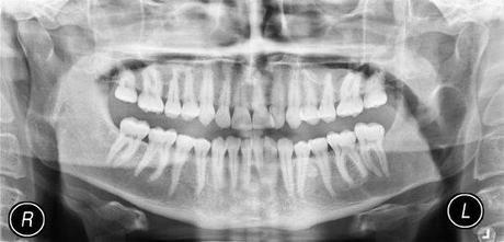 Tumore della tiroide: attenzione alle radiografie del dentista.