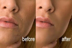 Ritoccare la pelle del viso con Photoshop - Pennello Correttivo, Filtro Sfocatura Superficie e Maschere di Livello