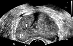 ecografia transrettale della prostata