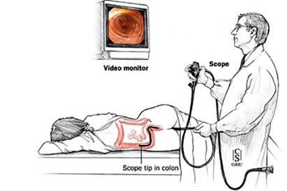 colonoscopia zemaniana