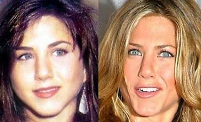 Le star prima e dopo il chirurgo: Jennifer Aniston