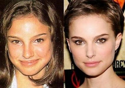 Le star prima e dopo il chirurgo: Natalie Portman