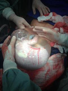Foto di un neonato nel suo sacco amniotico