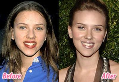 Le star prima e dopo il chirurgo: Scarlett Johansson