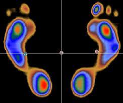 Esame Baropodometrico Statico e Dinamico