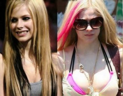 Le star prima e dopo il chirurgo: Avril Lavigne