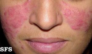 rosacea111349553413532