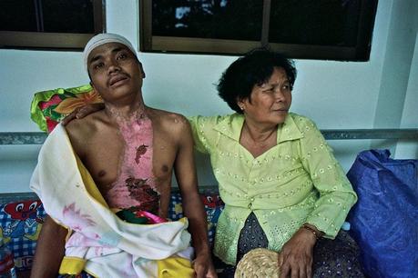 Kien Khleang National Rehabilitation Centre for Disabled, Chroy Changvar, Cambodia, 2012
