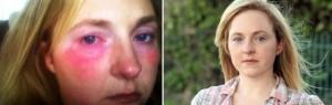 La ragazza allergica alla proprie lacrime: la diagnosi è orticaria acquatica