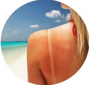 Abbronzatura: Scottature ed Eritemi Solari Rimedi Abbronzatura: Scottature ed Eritemi Solari Rimedi