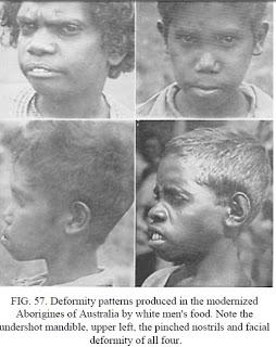 La perfezione fisica e mentale degli aborigeni australialiani e la loro degenerazione causata dalla dieta dell'uomo bianco