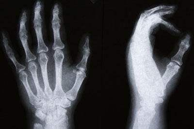 Artrosi alle mani, la prevenzione è fondamentale