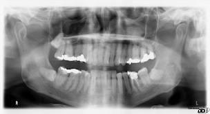 Radiografie dentali e tumori?