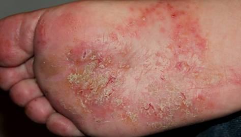 Eczema di piedi di medicina