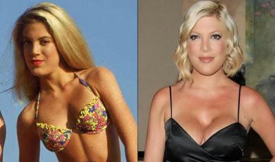 Le star prima e dopo il chirurgo: Tori Spelling