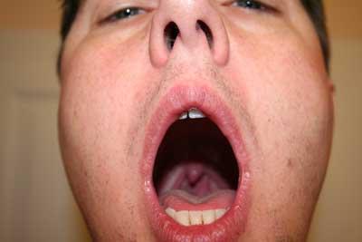 Mal di gola, rimedi naturali per affrontare i primi sintomi