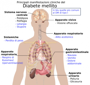 Conservazione cordone ombelicale - diabete di tipo 2