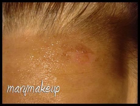 Mi sono bruciata e…Elizabeth Arden mi ha salvato! bruciatura_01