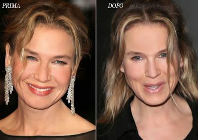 Le star prima e dopo il chirurgo: Renée Zellweger