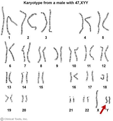 Disomia del cromosoma Y: non disgiunzione paterna in meiosi II