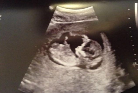 GB, Josie Cunningham pronta ad abortire: “Così posso fare il Grande Fratello”