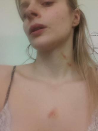 Francesca Cipriani finisce in ospedale: “il mio ex mi ha picchiata” e mostra i segni
