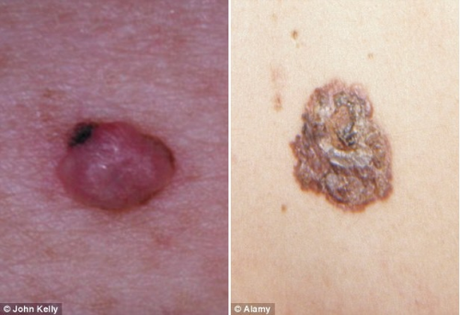 “Sembra brufolo ma è un tumore”: dermatologi, allarme melanoma nodulare