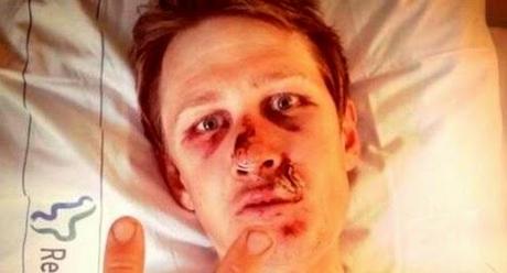 Caduta rovinosa per Larsson, vertebre fratturate e ferite al viso