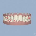 Invisalign, una soluzione “invisibile” per rendere “estetico” anche il trattamento ortodontico