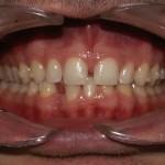 Invisalign, una soluzione “invisibile” per rendere “estetico” anche il trattamento ortodontico
