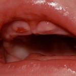 L’eruzione dei primi denti da latte (teething)… problemi e possibili rimedi