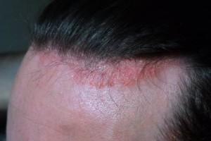 dermatite seborroica 300x200 Rosacea