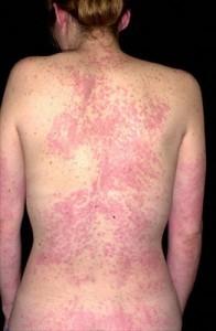 orticaria1 196x300 Orticaria