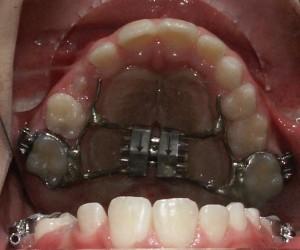Chiedi al dentista: espansore del palato