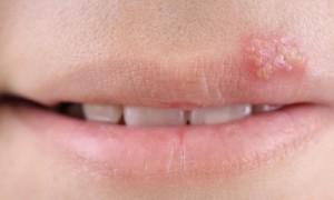 Avete problemi con i fastidiosi herpes? Combatteteli con i rimedi naturali!