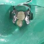 Intervista con il dentista: l’importanza dell’uso della ‘diga di gomma’
