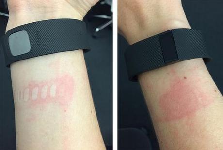 fitbit_irritation