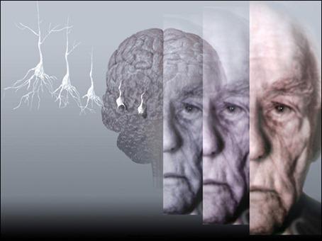 Alzheimer, vivere nei paesi freddi aumenta il rischio di ammalarsi