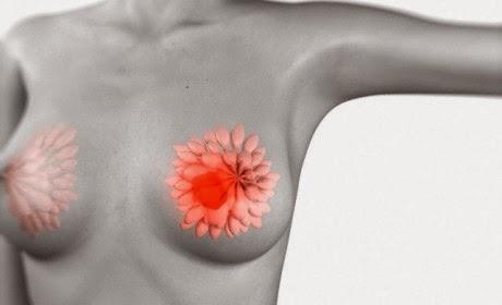 Tumore al seno: facciamo il punto