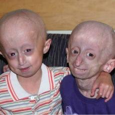 Noi scienziati disumani Progeria treatment - Drug therapy discovered for premature ageing disease in children_9254_1_1___Selected