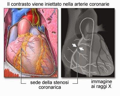 MILANO. La buona sanità: funziona la rete di assistenza ai cittadini con infarto miocardico