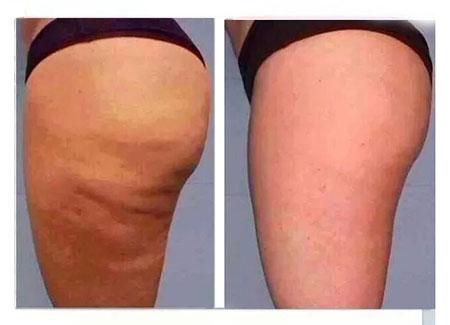 Dieta contro la cellulite, cibi consigliati e cibi da evitare