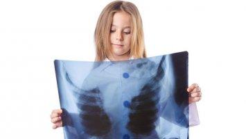 Bambini: troppi esami radiologici inutili bambina radiografia