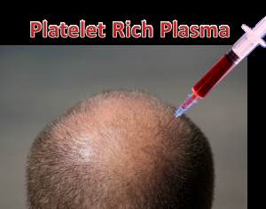 Plasma Ricco in Piastrine (PRP) per autotrapianti e calvizie. Serve davvero? (PRP) for autografts and baldness. Really it needs?