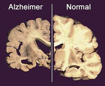 Alzheimer-spay